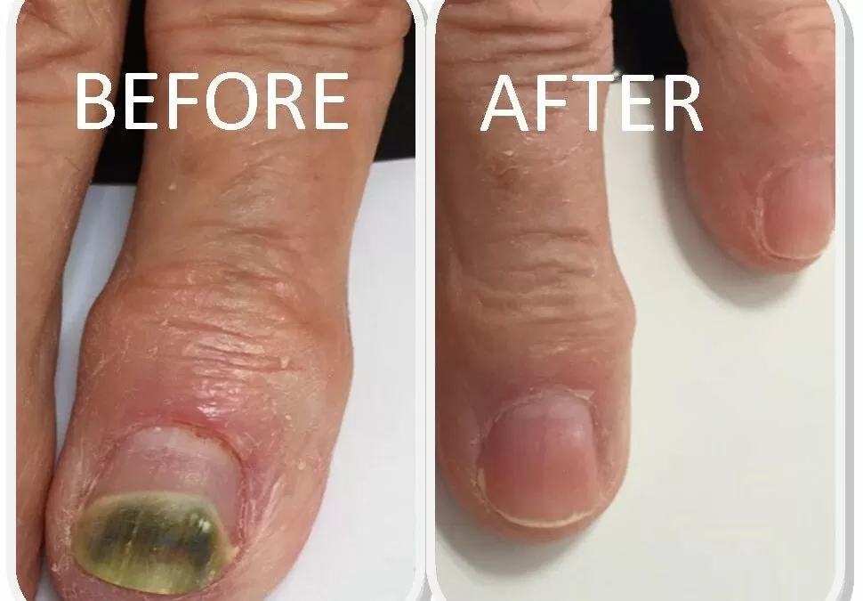 Before and after of a fungal nail treatment